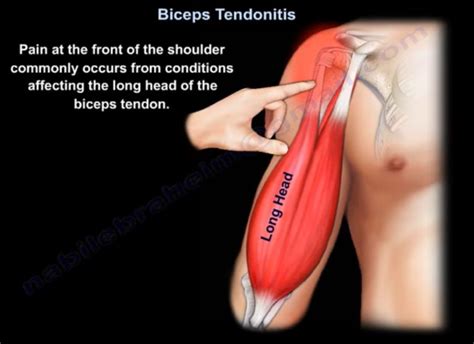 I'm suffering from tendons - is there anything to do?